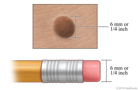 a mole, showing its width compared to a pencil eraser.