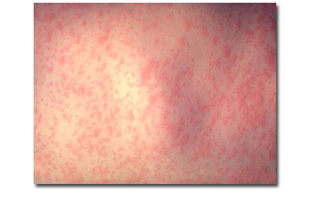 measles rash.