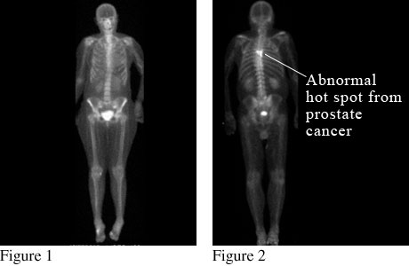 bone scan showing prostate cancer.