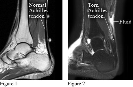 Normal Achilles tendon and torn Achilles tendon.