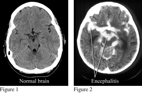 CT scans of normal brain and brain with encephalitis.