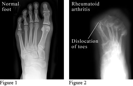 x-ray images of a normal foot and a foot with rheumatoid arthritis.