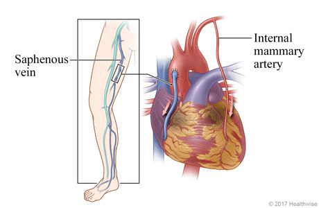 Location of saphenous vein in leg, and heart showing saphenous vein and an internal mammary artery used to bypass the diseased coronary artery.