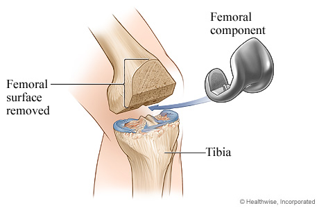 Knee replacement surgery: Femoral component.