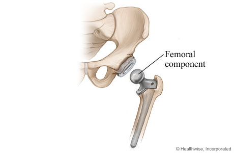 Hip replacement: Femoral component is placed.