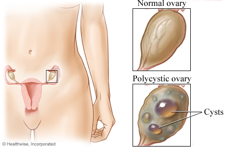 location of the ovaries with closeup of a normal ovary and a polycystic ovary.