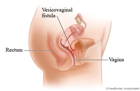 Vesicovaginal fistula.