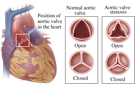 Location of aortic valve in heart with detail of normal open and closed valve and one with stenosis.