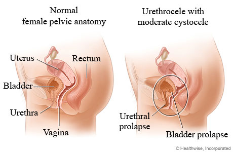 urethrocele.