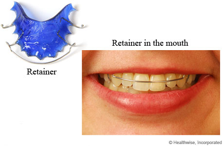 Retainer and photo of retainer in person's mouth.