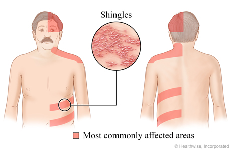 close-up of shingles rash and where shingles usually appears: top half of the head, neck and shoulders, and the belly or back area.