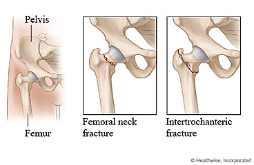 Picture of a hip and two types of hip fractures