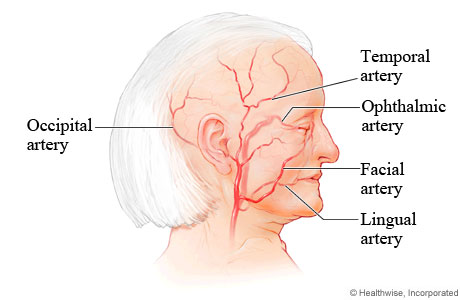 Arteries commonly affected by giant cell arteritis.