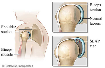 Shoulder and SLAP tear in the shoulder