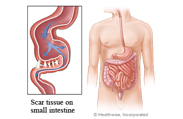 Picture of adhesions on the small intestine