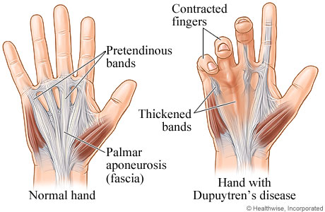 Normal hand and hand with Dupuytren's disease.