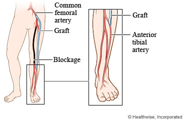 Grafted blood vessel around a blockage