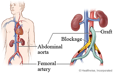 Aortobifemoral bypass