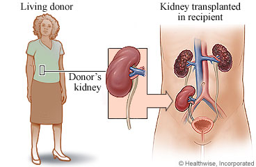 Kidney transplant