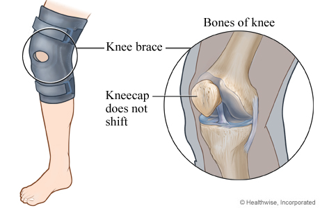 Knee brace to keep the kneecap from shifting.