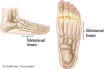 Metatarsal bones