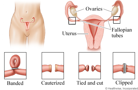 Location of fallopian tubes, with detail of the female reproductive system and tubal ligation methods