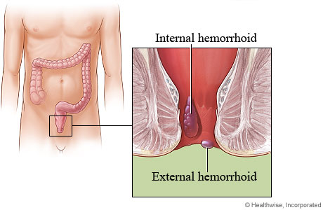 internal and external hemorrhoids.