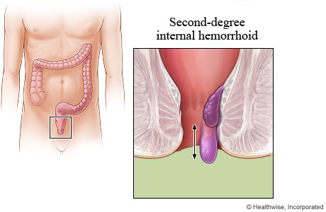 Second-degree internal hemorrhoid.