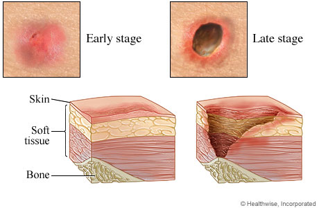Early-stage and late-stage pressure injuries.