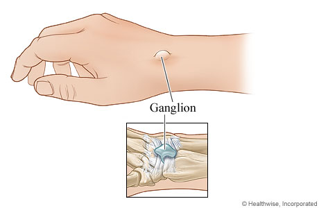 Dorsal wrist ganglion.