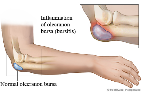 A normal bursa in the elbow compared to an inflamed one (bursitis).