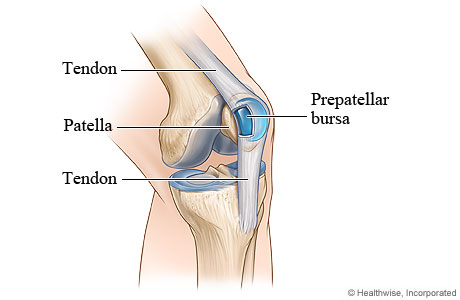 Bursitis of the knee.