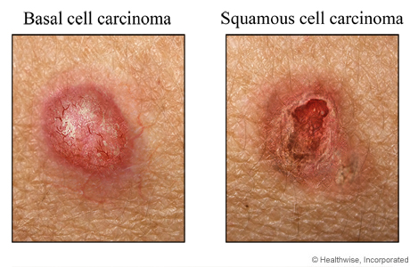 examples of basal cell carcinoma and squamous cell carcinoma.