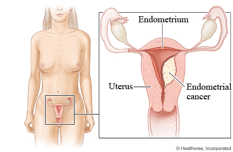Endometrial cancer.