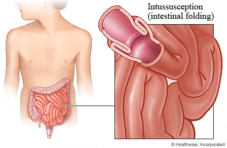 Intussusception.