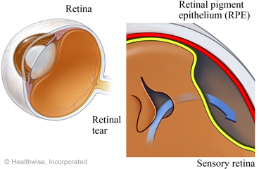 Detached retina