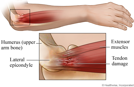 Tennis elbow anatomy: side view.
