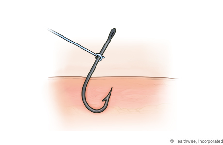String-pull method for removing a fish hook, step A: Tie a piece of string to the hook