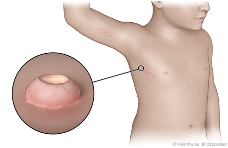 molluscum contagiosum on the chest, with close-up of an indented bump.