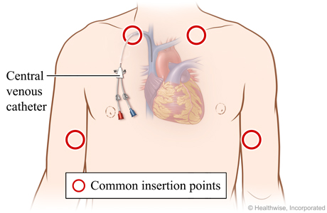 Areas on upper arms and upper chest where catheter may be put in