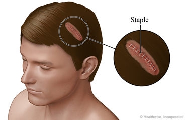 Cut closed with staples on scalp.