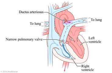 Heart with narrow pulmonary valve and change in blood flow