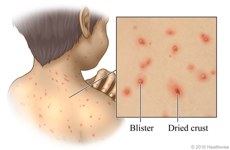 Typical chickenpox rash on back of a child, with close-up showing blisters and crusted sores.