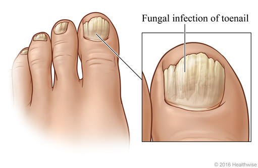 Toenails showing typical symptoms of the most common fungal nail infection, with close-up of big toe.