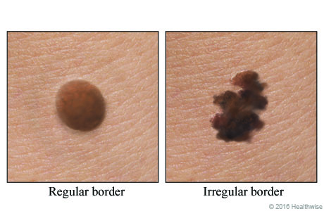 a normal mole and a mole with a ragged, notched border.