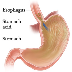 Gastroesophageal reflux disease (GERD)