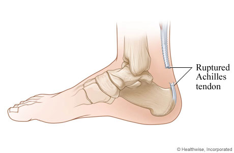 Ruptured Achilles tendon.