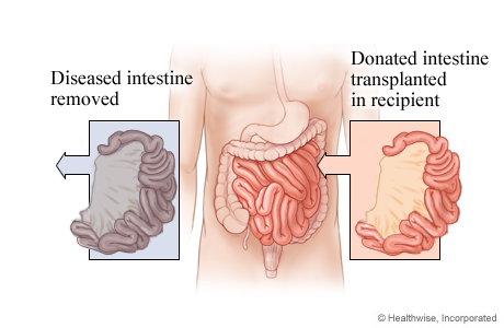 Intestinal transplant.