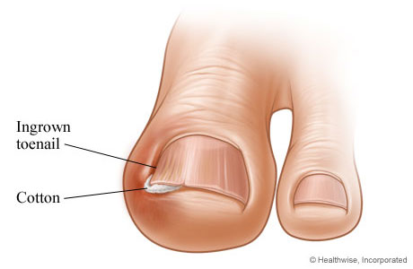 big toe with ingrown toenail, with cotton wedged under corner of toenail to treat it.