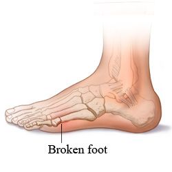 Broken foot